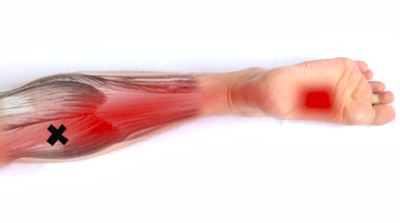Trigger points can cause pain in the calf in addition to polyneuropathy