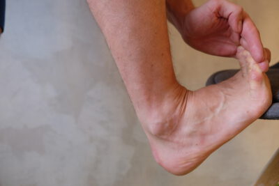 Stretching exercise for polyneuropathy