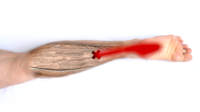 For heel pain, trigger points in the soleus muscle should be treated.